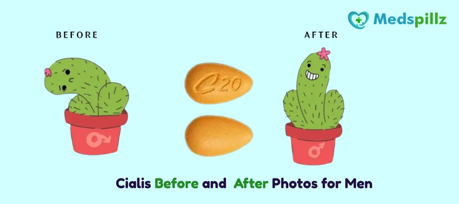 Cialis Before and After Photos for Men